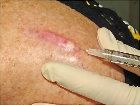 Intralesional Steroid Injections